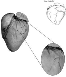 Figura 2 miocárdio de posição medial, sobre o ramo