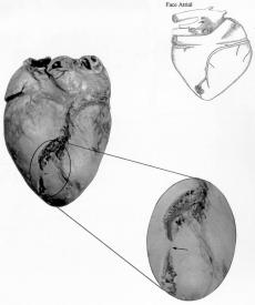 Figura 5 miocárdio de posição ventral, sobre o ramo ventricular subsinuoso.