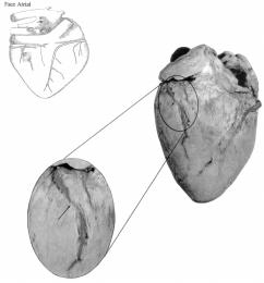 marginal caudal, da artéria coronária esquerda.