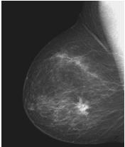 Negativos de imagens é uma técnica muito aplicada em imagens médicas. A imagem original abaixo é uma mamografia digital mostrando uma pequena lesão.