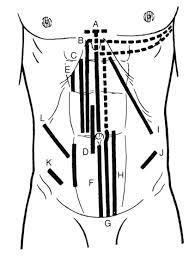 1) 2) 3) Incisões laparotomicas: A) Transversa parcial (Sprengel); em pontilhado o traçado para passar o total; B) Transversa infra-umbilical; em pontilhado ou prolongamentos para os flancos (Gurd);