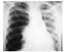 Alteração na pressão interpleural - pneumotórax Pulmão D Lado D do tórax cheio de ar Espaço entre costelas O