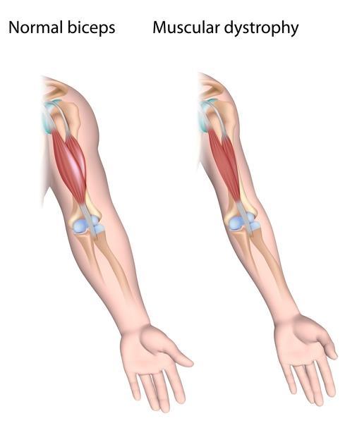 Atrofia Muscular Espinhal SMA é uma doença de herança autossômica recessiva, que atinge as células do corno anterior da medula principal causa de morte