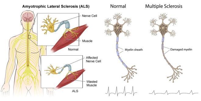 Esclerose Lateral Amiotrófica - ELA Doença de Lou Gehring ou Doença de Charcot Os neurônios motores alfa se desgastam ou morrem e já não conseguem mais mandar mensagens aos músculos.