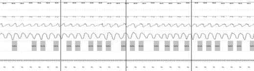 apnea in adults. A joint project sponsored by the American Academy of Sleep Medicine, the American Thoracic Society, and the American College of Chest Physicians.