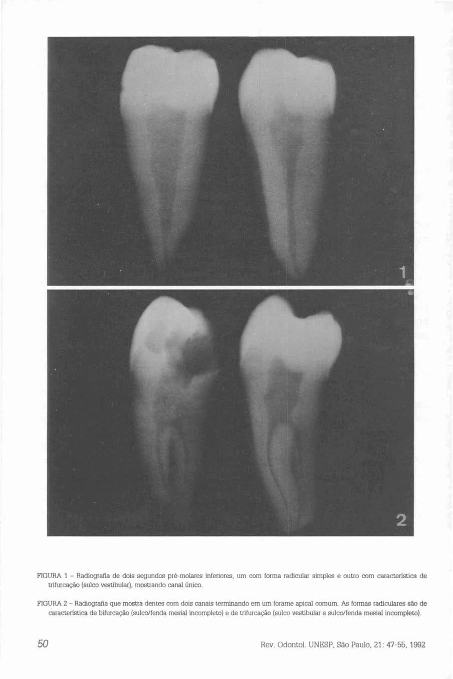 FIGURA 1 - Radiografia de dois segundos pré-molares inferiores, um com forma radicular simples e outro com caraeterlstica de trifurcação (sulco vestibular}, mostrando canal único.