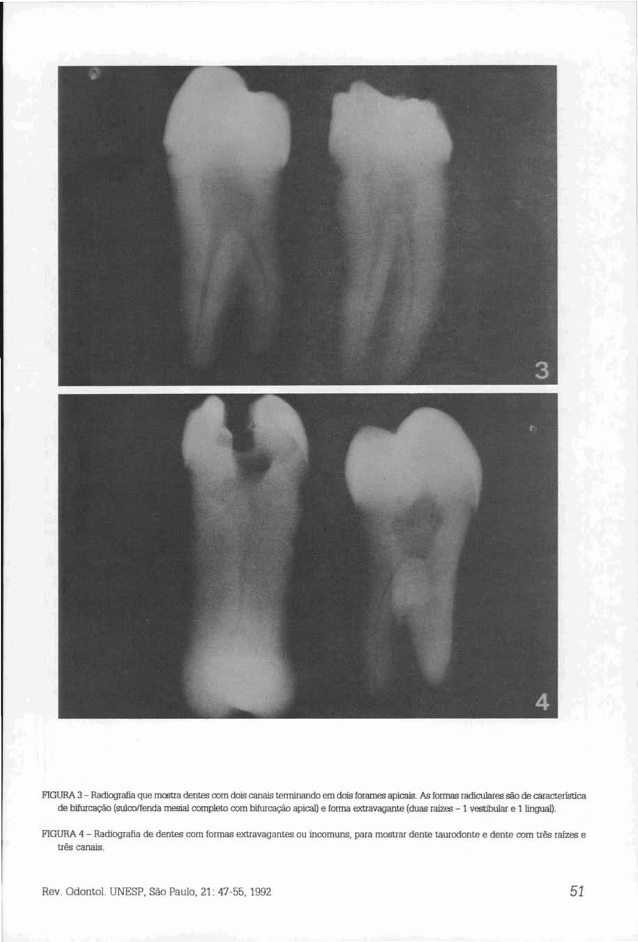 FIGURA 3 - Radiografia que mostra dentes com dois canais terminando em dois forames apicais.