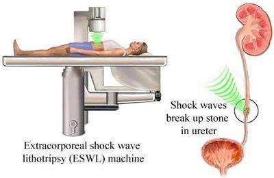 TERAPIA POR ONDAS DE CHOQUE EXTRACORPÓREA NA ESTÉTICA Histórico - 1950: Nos EUA a primeira patente de um gerador de ondas de choque para medicina - 1968-1971: Efeito das ondas de choque no tecido