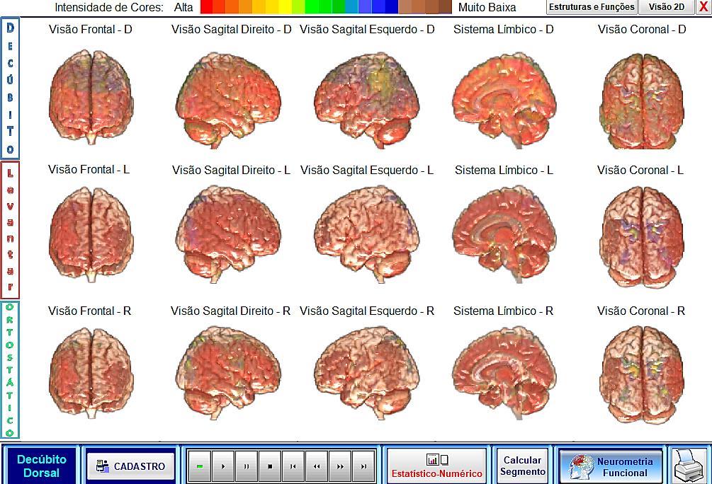 ANALISE NEURO FUNCIONAL Frontal Esquerdo Negatividade e Sensação de Infelicidade Hipersensibilidade (agitado/irritado) Sensação de entediado Baixo