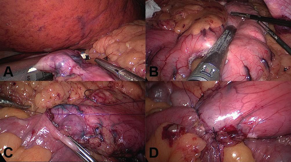A parte superior era o estômago; a inferior o pâncreas; a esquerda estava o duodeno e o piloro, e no direito o corpo do estômago.