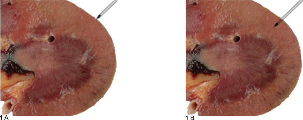 The Renal Biopsy