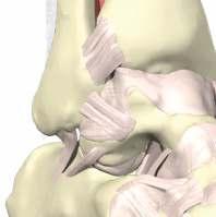 MEDICINA ESPORTIVA (a) (b) ( c) (d) Fastlock utilizada na realização de SLIN - Suporte Ligamentar Interno Fastlock Ø 35, 475 e 55 mm Âncoras em PEEK sem nó com ilhós, fio e fita para Suporte