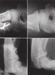 Fig. 6 Mesmo paciente da figura 4. Radiografias dos punhos, evidenciando discrepância de comprimento entre o rádio e a ulna, com colapso do primeiro, e a degeneração da articulação radioulnar distal.