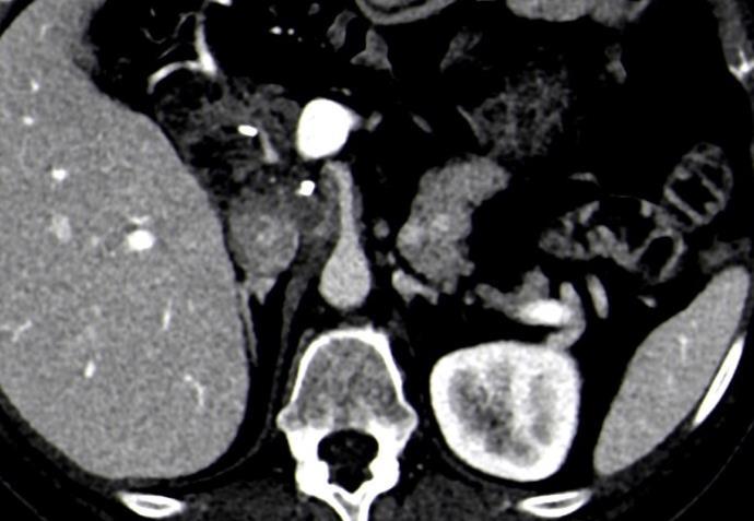 vasculares Fase arterial tardia (40/50 s)