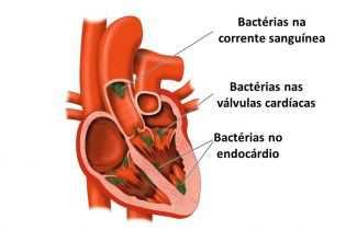 A proximidade anatômica entre a microbiotae os vasos sanguíneos facilitam a disseminação. Transitória-os microrganismos são geralmente eliminados em poucos minutos pelo sistema retículo endotelial.