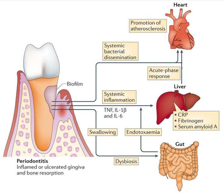 Antibioticoterapiaprofiláticavisando a Prevenção de Endocardite Bacteriana Prévia aos procedimentos odontológicos que envolverem manipulação dos tecidos gengivais ou da região periapical dos dentes