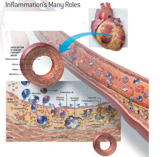 Endocardite infecciosa Prévia Transplantados cardíacos Wilson et al. Prevention of Infective Endocarditis. Circulation.