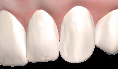 Para esses dentes, sugerimos um leve recontorno incisal, simulando o desgaste natural antes da