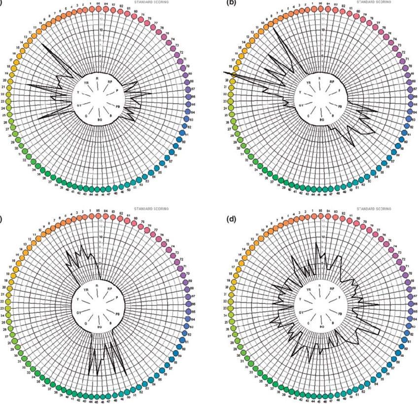 31 FIGURA 5: Gráficos polares do teste de Farnsworth-Munsell 100-hue mostrando defeitos da sensibilidade cromática dos tipos protan (a), deutan (b), tritan (c) e inespecífico (d).