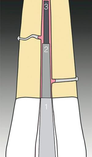 Fonte: https://delendo.com/delendo-library/the-continuous-wave-of-obturation-technique-part-1-2/ Dispositivos Eletrônicos para a obturação tridimensional.