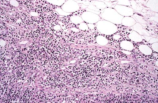 6 Figura 2 Extensão da infiltração além da cápsula. Infiltração na gordura, com preservação dos seios corticais que parecem ser saltados pelas células do tumor. Fonte: Adaptado de JAFFE, E.S.