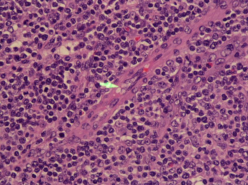 fibroblastos, histiócitos e células epitelioides. Fonte: JAFFE, E.S.et al, 2016.