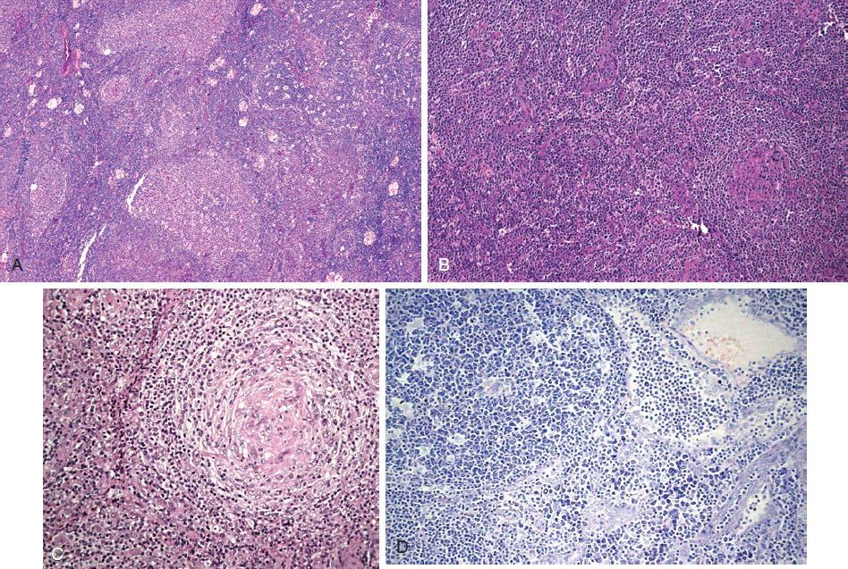 8 No passado acreditava-se que a presença de centros germinativos hiperplásicos reativos de células B não estaria presente nos casos diagnosticados com AITL, entretanto, já é de conhecimento que a