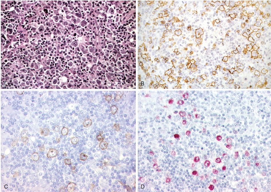 12 B. O diagnóstico do linfoma de grandes células B pode ocorrer em um momento inicial da investigação ou com a evolução da neoplasia.