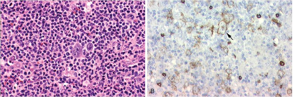 13 negativo, CD30 positivo, CD15 positivo) em uma histologia típica de AITL (FIG. 10) (JAFFE, 2017). Figura 10.