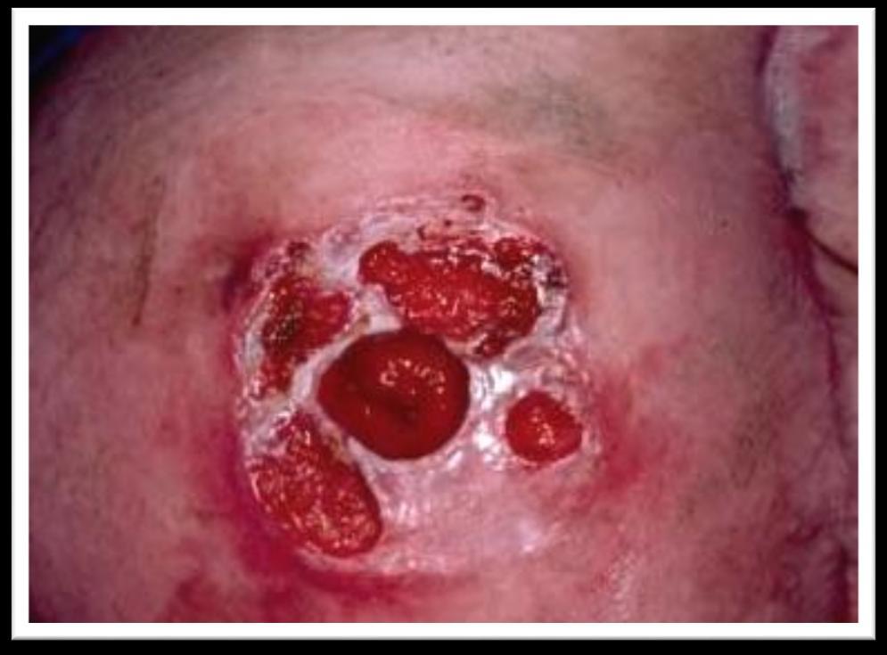 56 Pioderma Gangrenoso Pioderma Gangrenoso ou Ulceração cutânea também é um tipo de irritação de pele e está relacionada à doença de Crohn. Este tipo de dermatite é raro e surge espontaneamente.