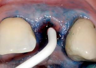 A Com base na literatura disponível e em nossa experiência, a TFDa ainda aparece como um tratamento adjuvante promissor em casos de doença periodontal, principalmente na periodontite agressiva casos