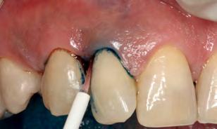 Após 90 dias, significante redução foi observada no grupo da TFDa em relação ao grupo da RAR. Por outro lado, a RAR mostrou-se mais eficiente na redução de patógenos periodontais do complexo vermelho.