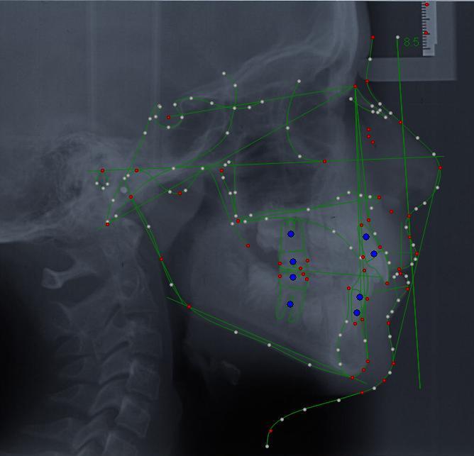 Figura 1: Representação dos pontos cefalométricos após processamento com o software Dolphin Imaging Tabela 1: Descrição das variáveis cefalométricas obtidas e calculadas pelo software Dolphin Imaging