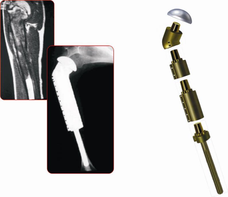 Demonstração das formas de implantação do sistema: Material de Apoio Os materiais de apoio são os instrumentais designados unicamente para implantação do Sistema Não Convencional Para Ombro.