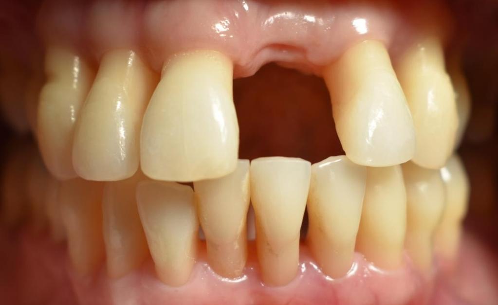 Figura 4. Paciente apresenta sucesso após o tratamento periodontal. Portanto, classificado como doença periodontal controlada/ em remissão.
