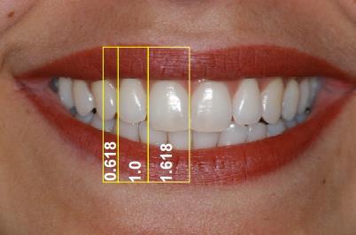 3 Figura 1 Dominância dos incisivos centrais e posterior aparecimento gradual dos dentes seguintes, segundo a proporção áurea.