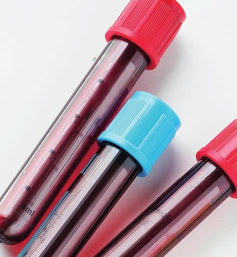 SINAIS DE INFLAMAÇÃO As proteínas encontradas no sangue e nas fezes, também chamadas de biomarcadores, podem ser úteis para detectar a inflamação.