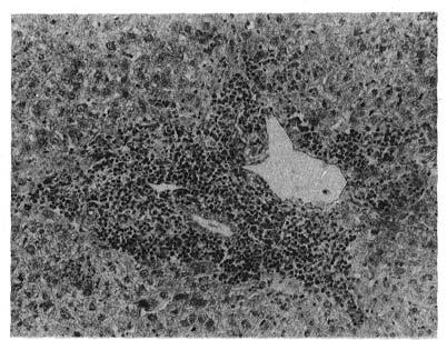 principalmente ao nível dos espaços porta; nesses infiltrados, que penetram e destroem o parênquima hepático, notam-se hepatócitos com sinais degenerativos e inúmeras figuras de mitose (Fig. 2 e 3).