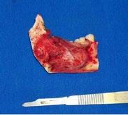 A paciente foi encaminhada para o médico cirurgião de cabeça e pescoço, que em conjunto com o cirurgião bucomaxilofacial e o médico ortopedista planejaram como forma de tratamento a