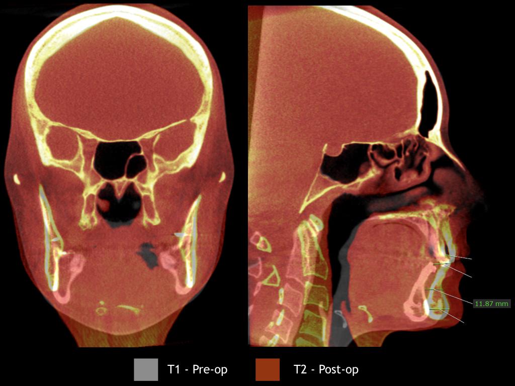 ANEXO A Figura 01: Corte coronal da TCFC mostrando a superposição tomográfica utilizando a base do crânio como referência.