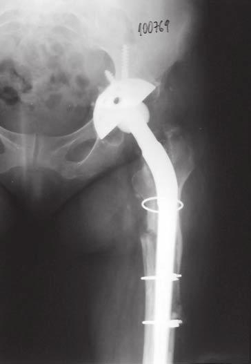 A remodelação óssea proximal, avaliada nas radiografias da última consulta ambulatorial, foi dividida, segundo Callaghan et al (2), em: tipo A oito casos (4%), tipo B 27 casos (13%) e tipo C 162