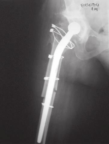 TABELA 5 Classificação de Callaghan et al para remodelação óssea Tipos Casos % A 008 004 B 027 013 C 162 083 Total 197 100 Figura 4 Osteointegração (D) após osteotomia de Wagner que foi fixada com