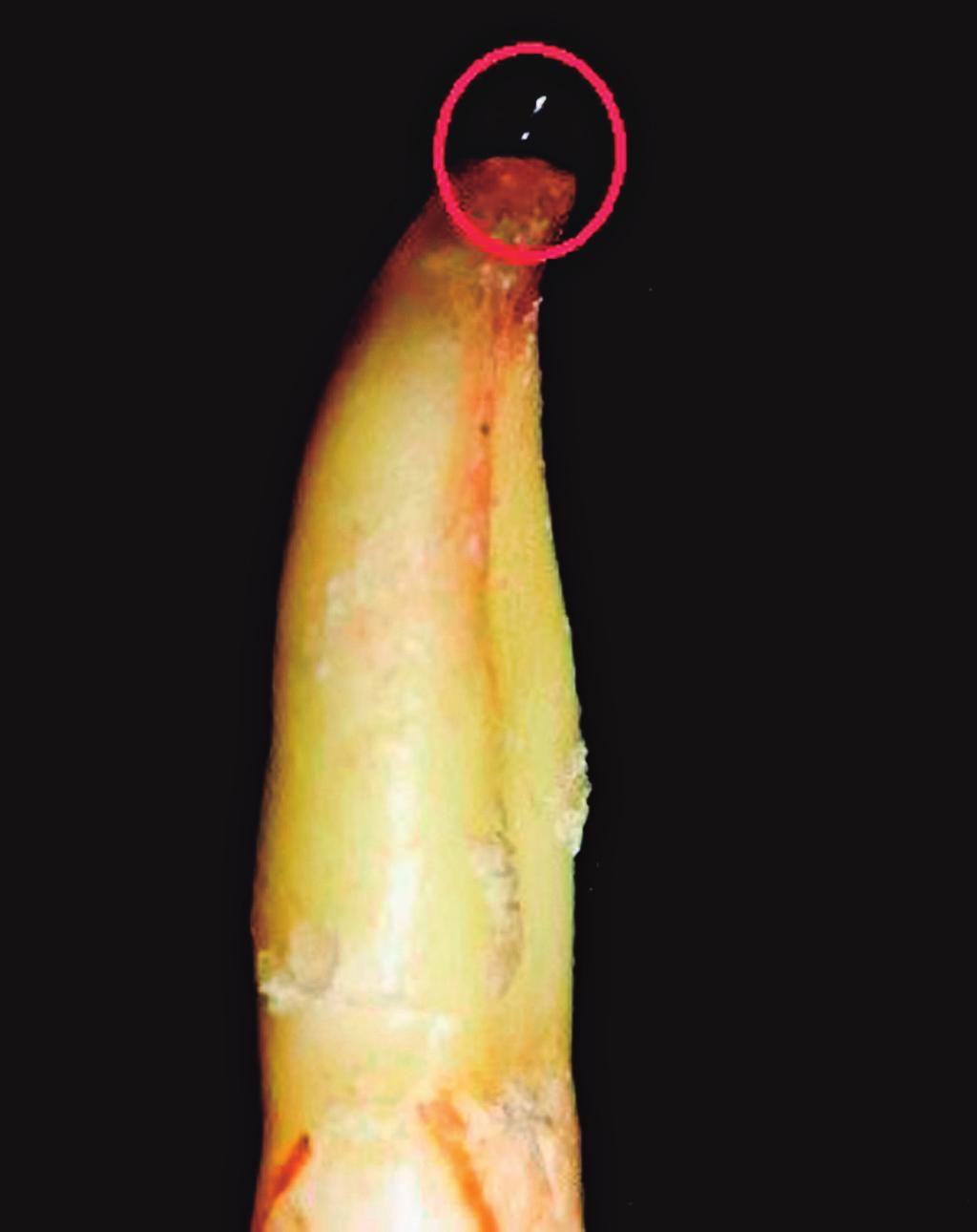 FIGURA 1 Lima #10 ultrapassando o forame FIGURA 2 Lima sendo recuada grafia no sentido mésio-distal foi realizada para a verificação da qualidade da obturação em todos os elementos dentários.