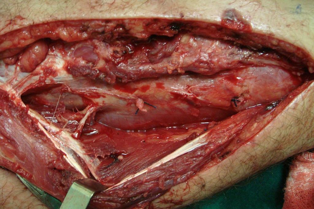 Técnica Cirúrgica A incisão cutânea longitudinal é feita na face medial da perna, acompanhando paralelamente a borda medial da tíbia.