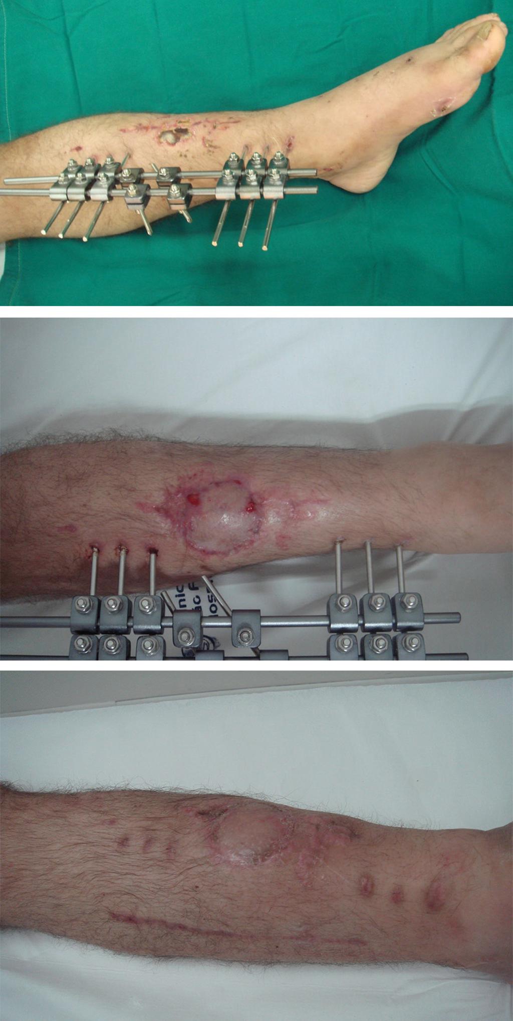 a confecção do retalho variou de 4 a 28 dias (tempo médio de 17,7 dias). Todos os pacientes evoluíram com cicatrização completa da ferida.