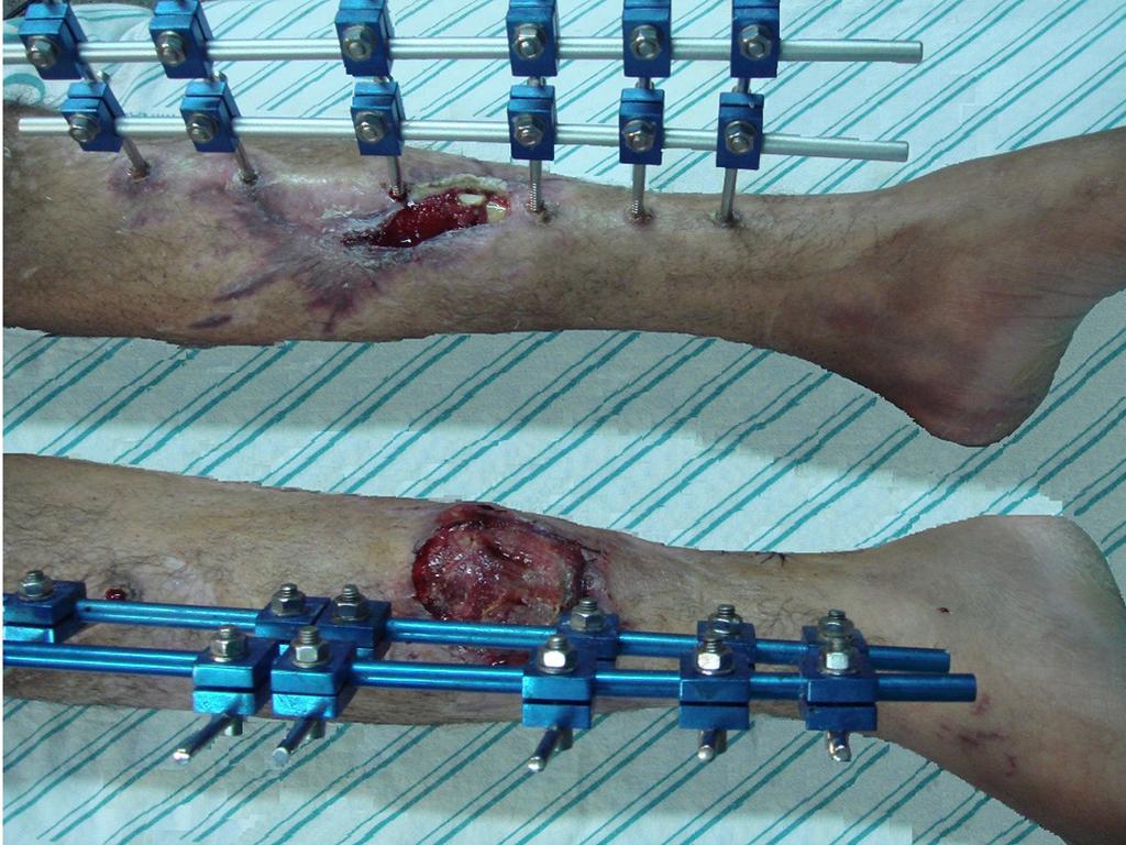 Retalho muscular de hemisóleo medial A A B B Figura 12. A: Perna direita com retalho confeccionado e perna esquerda com fratura exposta de tíbia; B: Pós-operatório de 24 meses.