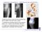 implantes ortopédicos deficiências das articulações