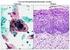 Neoplasias Intraepiteliais Cervicais