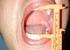 Avaliação da abertura bucal em pacientes submetidos à radioterapia de cabeça e pescoço