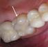 Ceramic Onlay Posterior Tooth Restoration: a Case Report